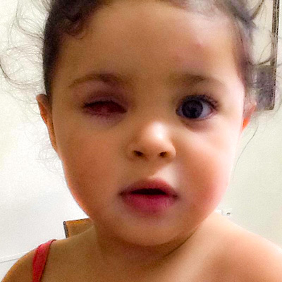 Retinoblastoma